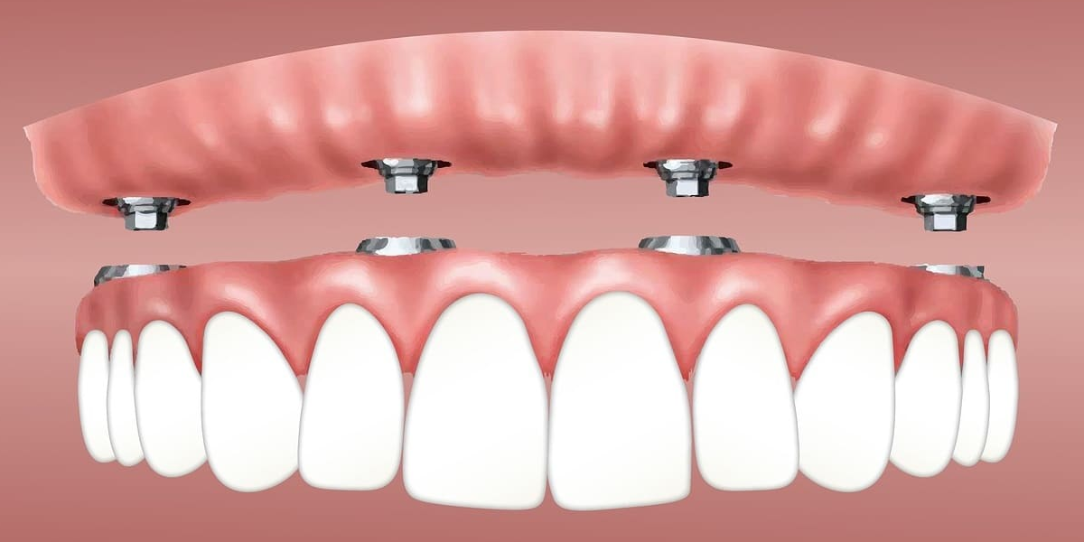  guide for all on 4 dental implants 