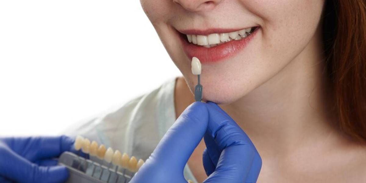 teeth veneers cost in india 